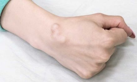 Penyakit Kista Kenali Gejala, Penyebab Dan Cara Penanganannya