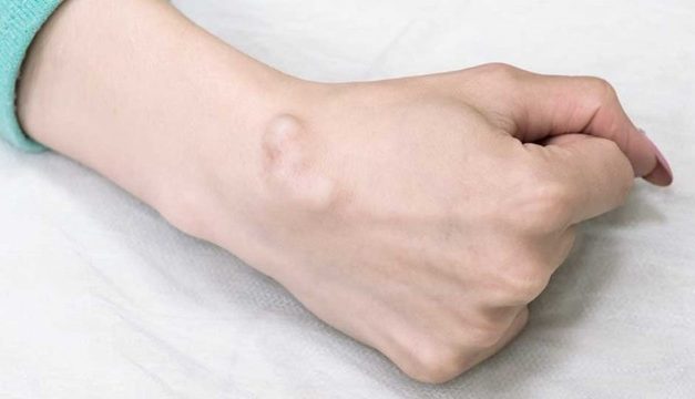 Penyakit Kista Kenali Gejala, Penyebab Dan Cara Penanganannya