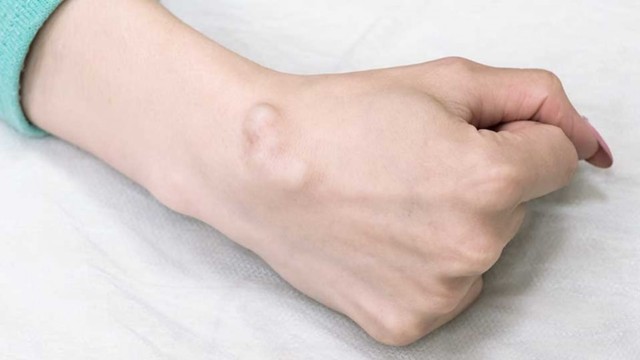 Penyakit Kista Kenali Gejala, Penyebab Dan Cara Penanganannya