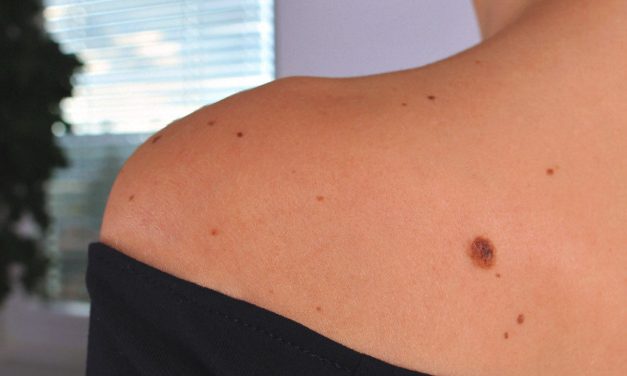 Nevus, Tahi Lalat Yang Tampak Sepele Namun Berisiko