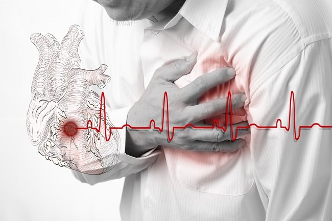 Angina Pectoris, Nyeri Dada sebagai Peringatan Penyakit Jantung