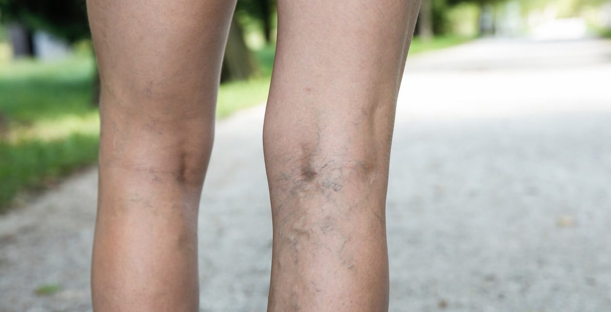 Varises, Penyebab, Gejala Dan Cara Mengatasinya