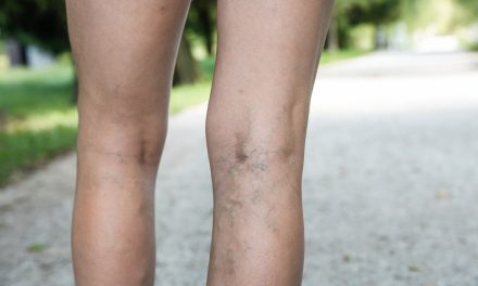 Varises, Penyebab, Gejala Dan Cara Mengatasinya