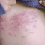 Penyakit Lupus, Cari Tau Penyebab Dan Pencegahannya