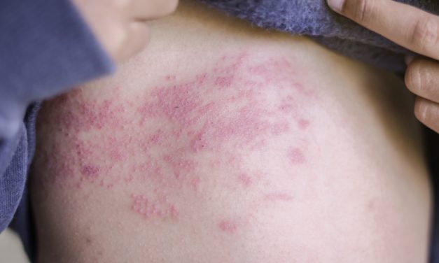 Penyakit Lupus, Cari Tau Penyebab Dan Pencegahannya