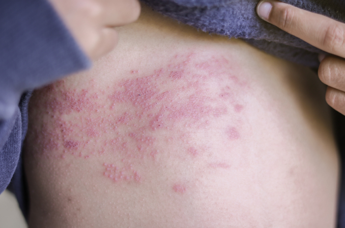 Penyakit Lupus, Cari Tau Penyebab Dan Pencegahannya