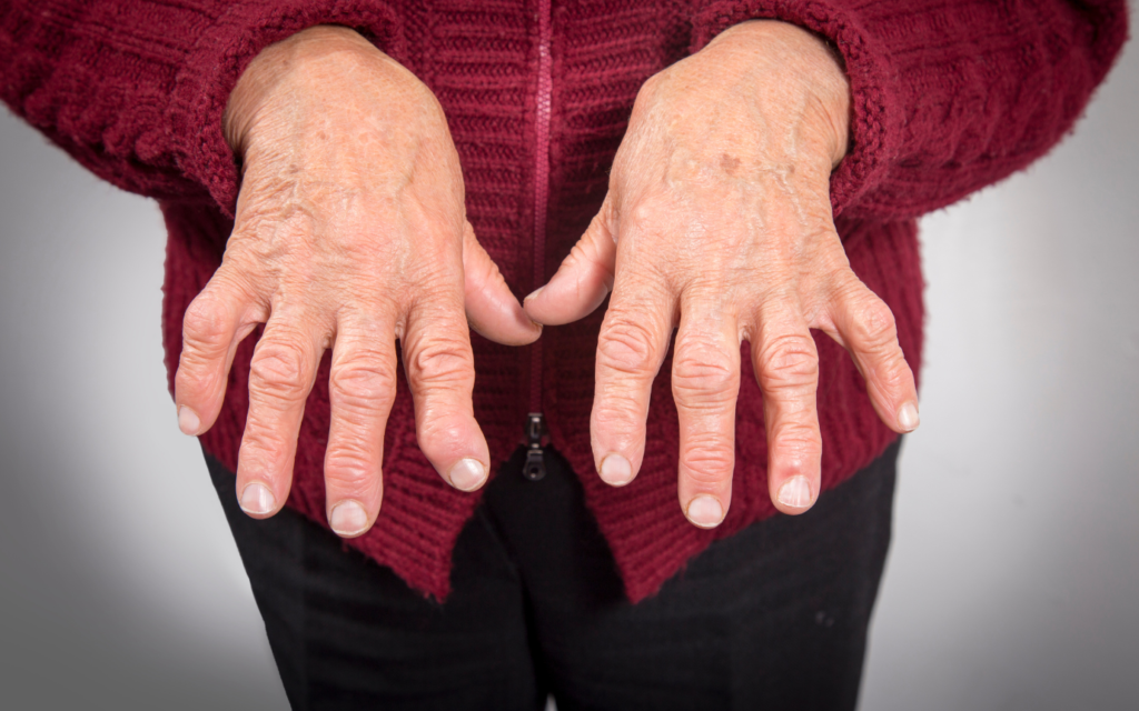 Rheumatoid Arthritis Di Tandai Oleh Peradangan Pada Sendi