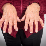 Rheumatoid Arthritis Di Tandai Oleh Peradangan Pada Sendi