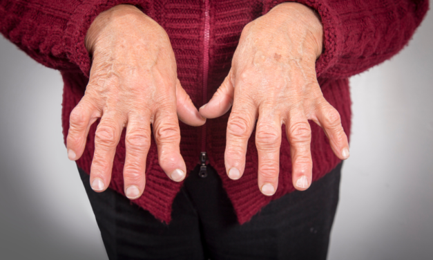 Rheumatoid Arthritis Di Tandai Oleh Peradangan Pada Sendi