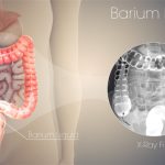 Barium Enema, Prosedur Medis Untuk Deteksi Gangguan Usus