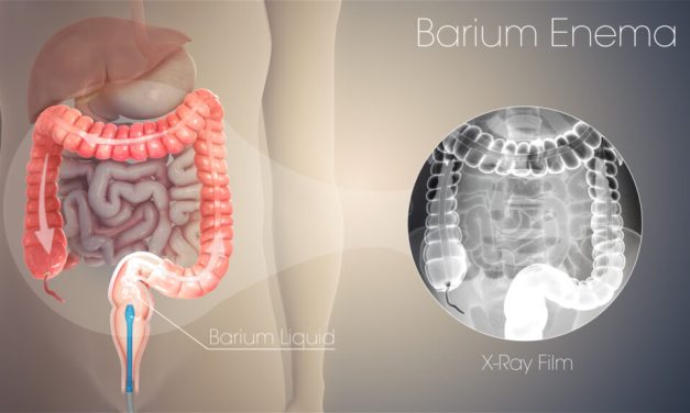 Barium Enema, Prosedur Medis Untuk Deteksi Gangguan Usus