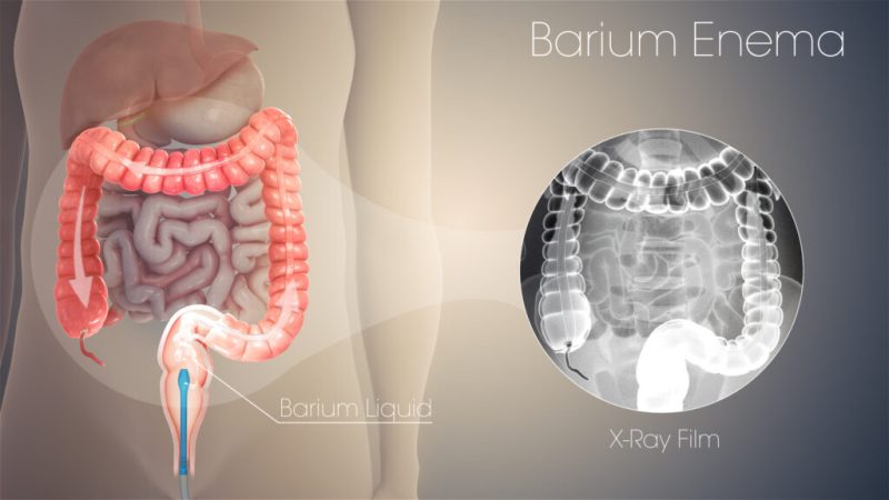 Barium Enema