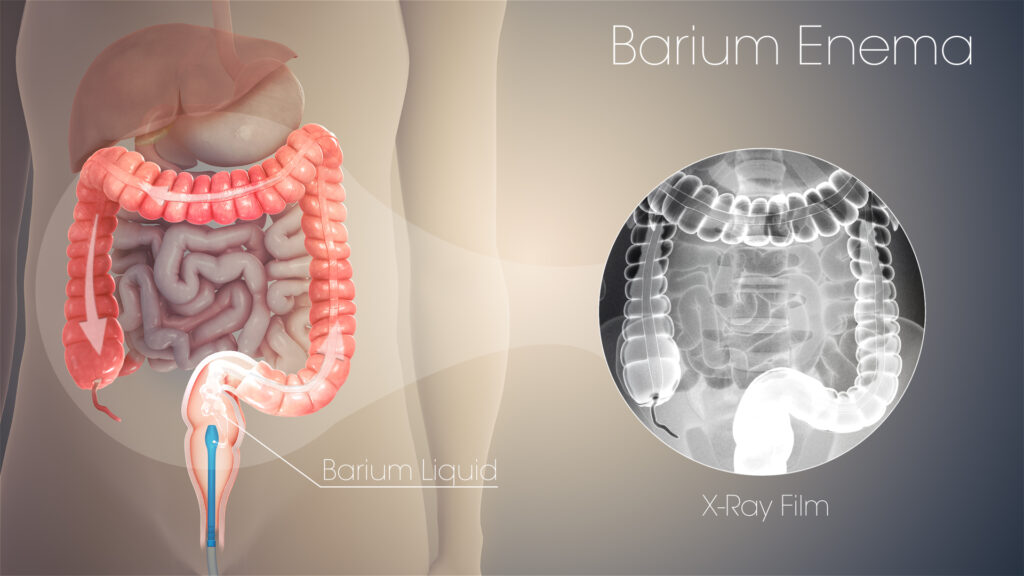 Barium Enema, Prosedur Medis Untuk Deteksi Gangguan Usus