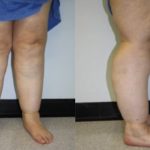 Lipoedema Penyebab Pembesaran Paha Meski Sudah Diet