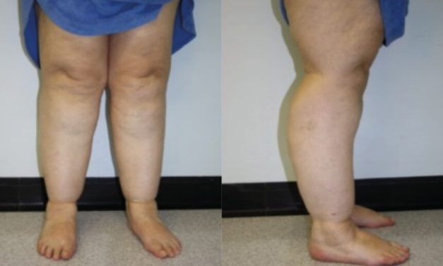 Lipoedema Penyebab Pembesaran Paha Meski Sudah Diet